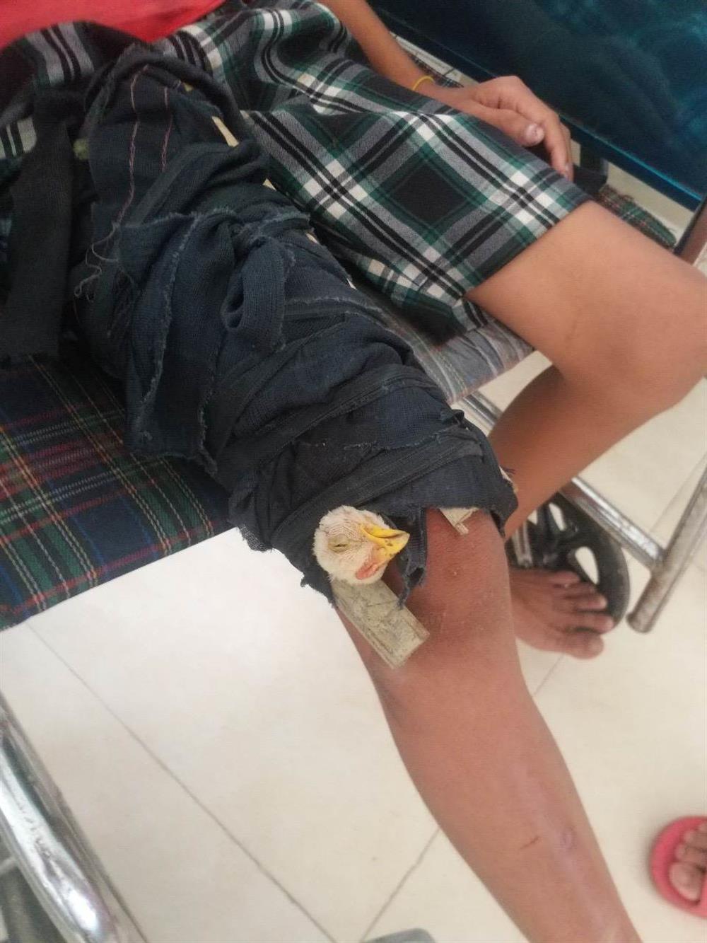 Hình ảnh người dân mê tín bó con gà vào vết thương ở chân để mong vết thương chóng lành.