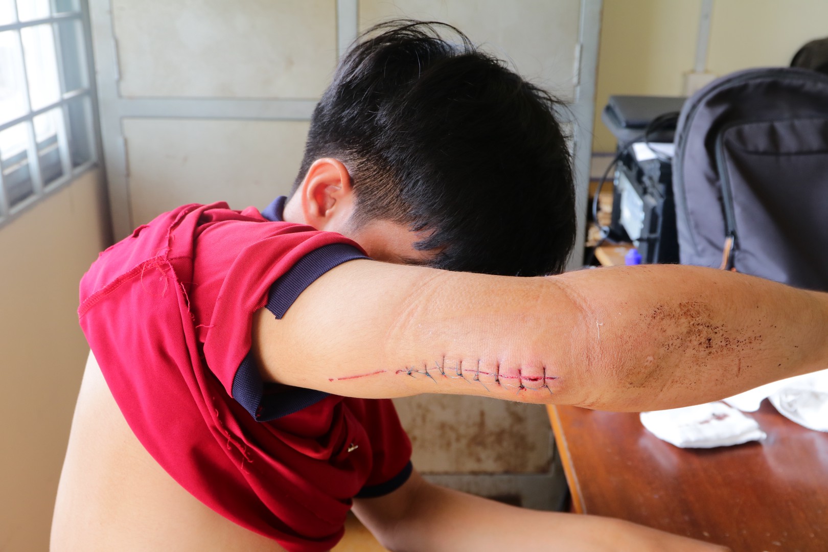 Vết thương bị chém của bị hại.JPG